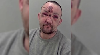 Retrato de un hombre de cabello corto con barba. Muestra hinchazón, hematomas y heridas en la frente, nariz y alrededor de los ojos, vistiendo una camiseta gris.