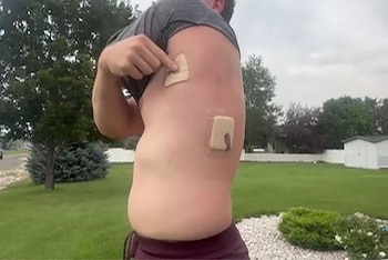 Un hombre de perfil muestra su torso con dos parches rectangulares sobre la piel. Su mano toca uno de los parches. Hay árboles y césped en el fondo