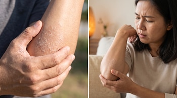 Primer plano de un codo con piel seca y escamosa. Mujer mira su brazo y codo con expresión de preocupación por la sequedad de la piel.