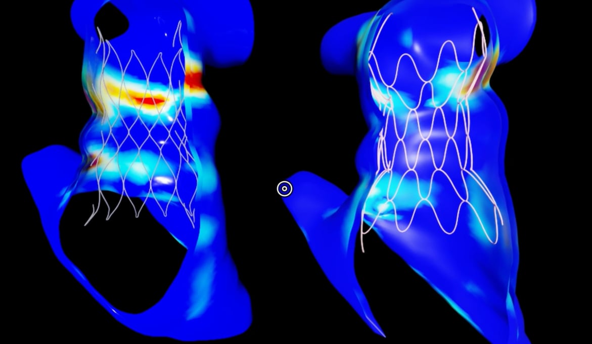 El sistema analiza tomografías, resonancias magnéticas y ecografías 3D para reconstruir la anatomía cardíaca pediátrica. (Nvidia)