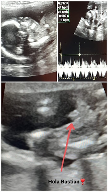historia de subrogación Matias y Leo