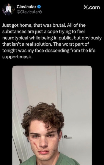 Streamer Clavicular fue hospitalizado por presunta sobredosis