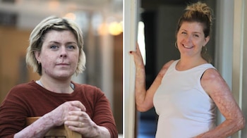 Emma Schols, la madre que se quemó el cuerpo entero para salvar la vida de sus hijos. (Imagen: Facebook)