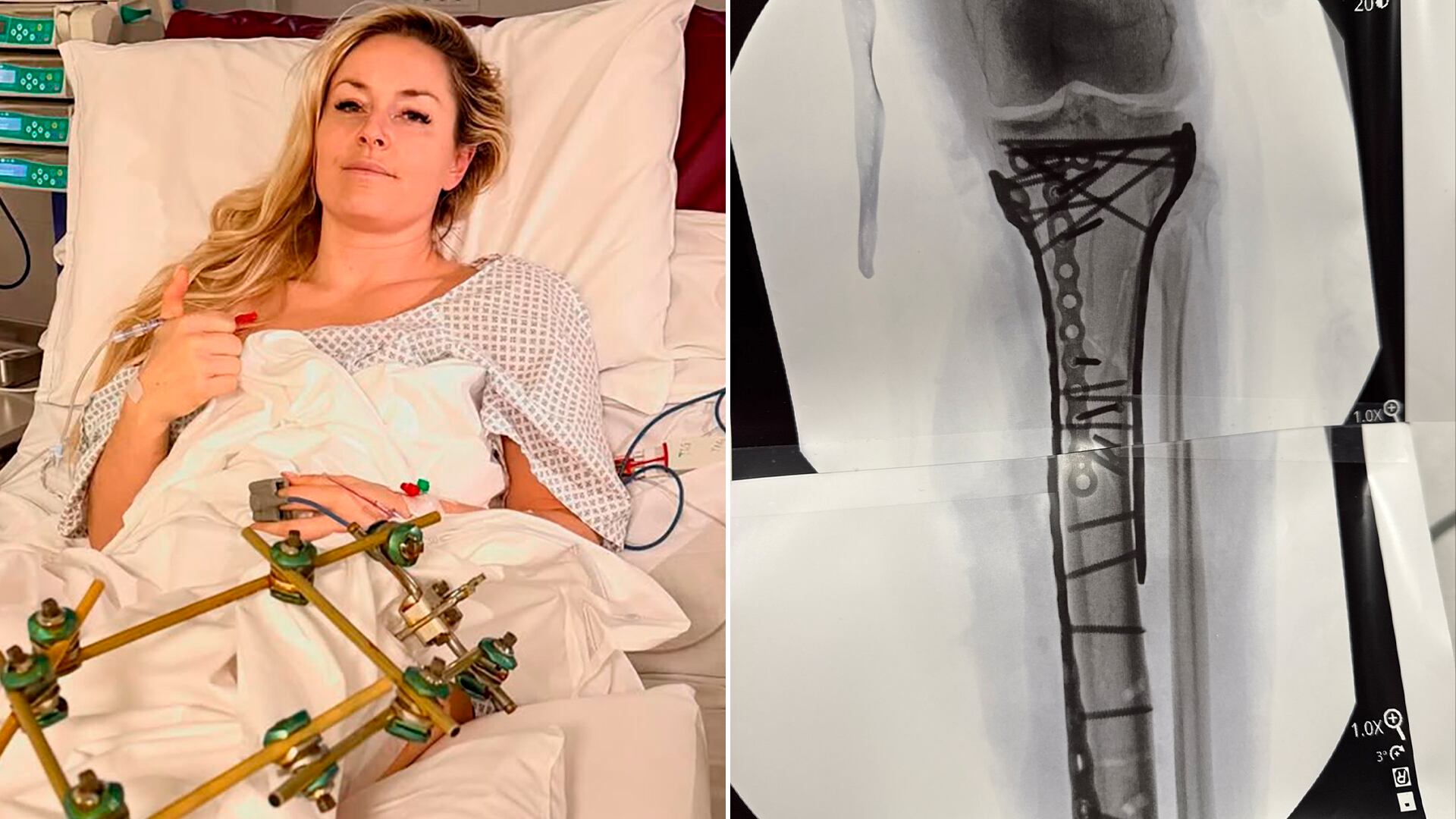 La impresionante imagen que compartió Lindsey Vonn tras una nueva operación por su fractura en los Juegos Olímpicos: “He tenido algunas dificultades”