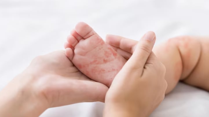 El regreso del sarampión en San Francisco: un bebé no vacunado, primer caso en siete años