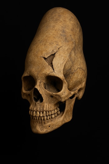 Las tomografías del cráneo de