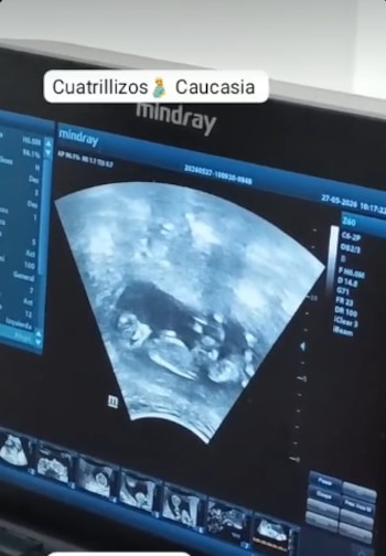 Jonatan Zapa señaló que no existe registro previo de un caso similar en Colombia - crédito cuatrillizos Caucasia/TikTok