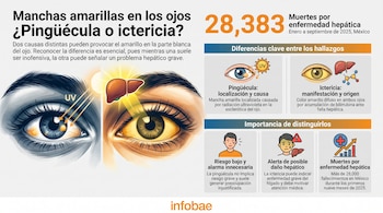 Infografía sobre pingüécula e ictericia con ilustraciones de dos ojos, uno con mancha amarilla localizada y otro completamente amarillo. Incluye gráficos y un hígado.