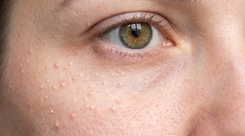 Primer plano de un ojo y piel clara con múltiples protuberancias blanquecinas diminutas sobre el pómulo.