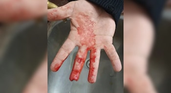 Así quedó la mano del oficial herido (Gentileza: Diario Norte)