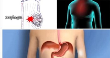 También conocido como esófago de