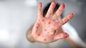 Alerta sanitaria en Argentina: sarampión,