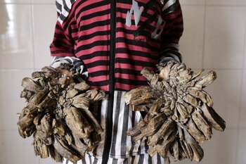 Solo 200 casos del síndrome del hombre árbol han sido registrados en la historia médica (EFE)