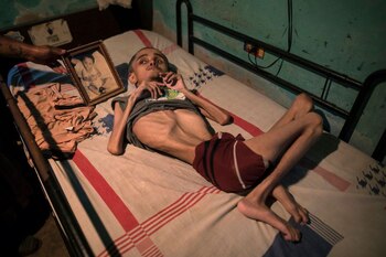 Miguel Blanco nació con hidrocefalia.