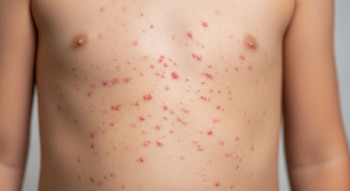 Primer plano del torso y parte de los brazos de un niño con numerosas manchas redondas de color rojo y relieve sobre la piel clara.