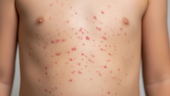 Las autoridades de Nueva Jersey alertan sobre riesgo de sarampión en el aeropuerto de Newark