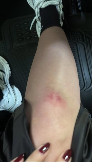 Además del esguince, la actriz