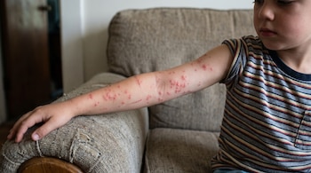 Primer plano del brazo de un niño con numerosas picaduras rojas y elevadas de insectos, posiblemente chinches, mientras está sentado en un sofá.