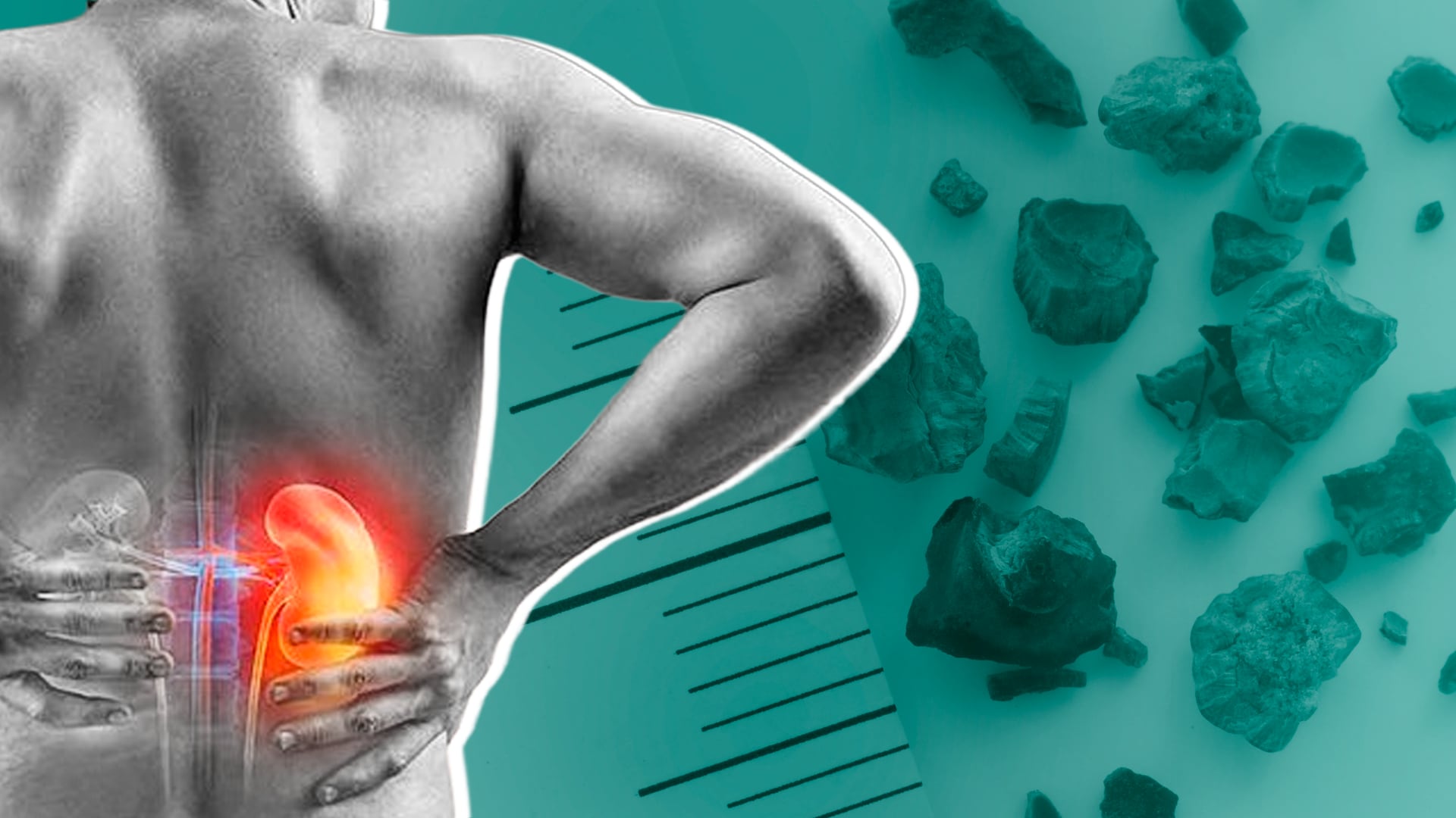 Los estudios médicos descartaron la apendicitis inicial y diagnosticaron cálculos renales y una oclusión en el colon como causas del dolor. (Infobae México/ Jesús Aviles)