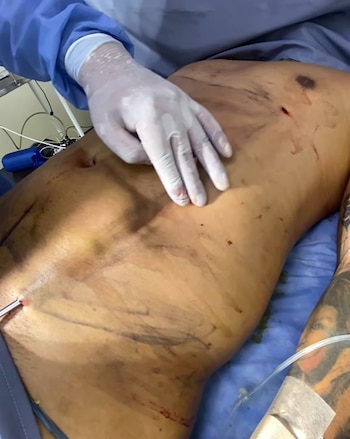 Mauricio Bastidas tras su cirugía