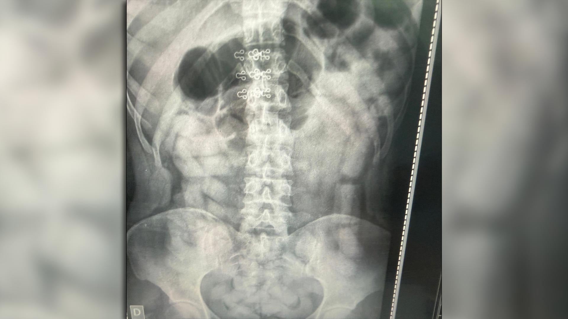 Una radiografía muestra múltiples cápsulas de cocaína dentro del cuerpo de una persona, parte de un hallazgo de más de 500 cápsulas en diez individuos detectados por Gendarmería en Tucumán.