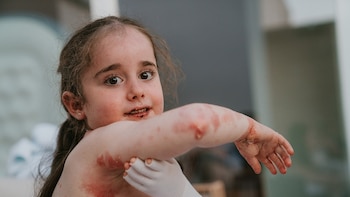 Así es Vyjuvek, el tratamiento