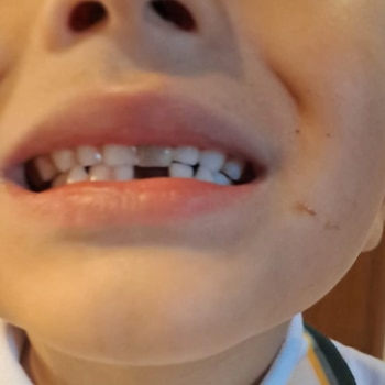 Primer plano de la boca de un niño que sonríe, mostrando un espacio donde falta un diente frontal inferior. Se aprecian encías y los demás dientes