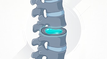 Ilustración de vértebras lumbares en corte que expone un disco intervertebral con una sustancia celeste en su interior.