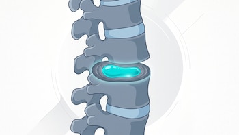 Un gel inyectable busca aliviar el dolor lumbar y reparar discos de la columna: qué revelaron los ensayos clínicos