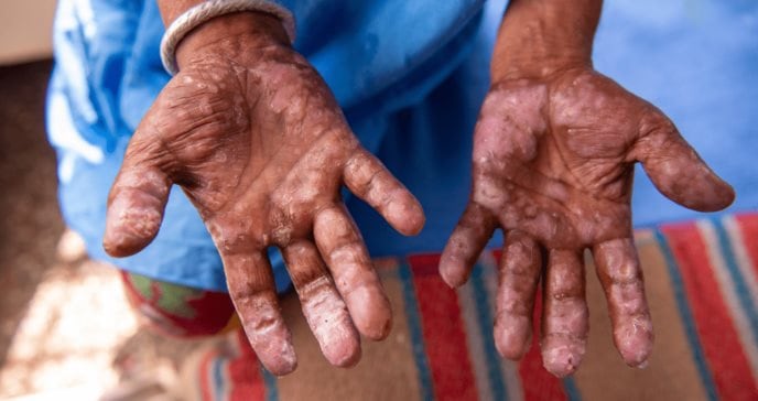 Cuba diagnostica lepra todos los años y acumuló 124 casos durante 2025