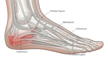 Ilustración médica de un pie humano visto de lado, revelando los huesos como el calcáneo y metatarsianos, la fascia plantar y un área de inflamación en rojo.