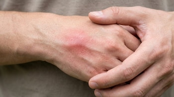 Primer plano de dos manos humanas; una muestra una roncha grande, roja e inflamada en el dorso, mientras la otra la sostiene o cubre. El fondo está desenfocado.