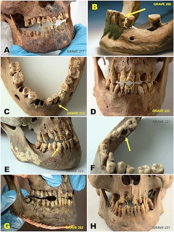 Ocho imágenes de mandíbulas y maxilares humanos antiguos con dientes, mostrando desgaste, pérdida y cavidades; algunas con flechas o círculos amarillos que resaltan detalles específicos