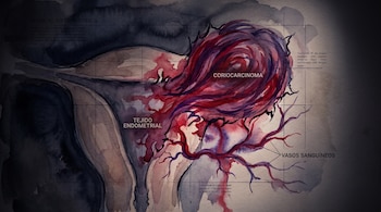 Ilustración en acuarela de un tumor de coriocarcinoma, tejido endometrial, vasos sanguíneos y texto.