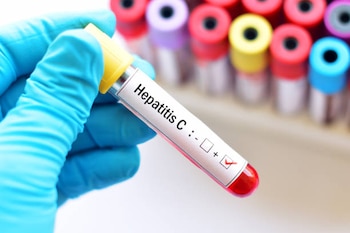 Detectar a tiempo la Hepatitis C puede evitar cirrosis y cáncer de hígado. Foto: (iStock)