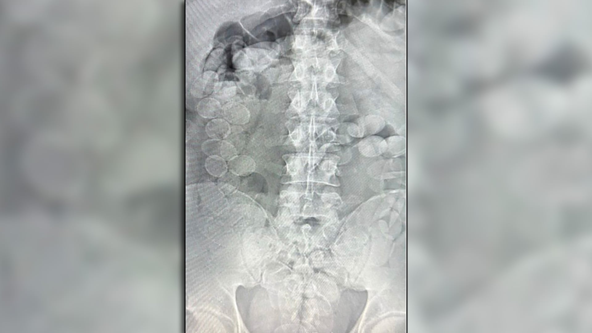 Radiografía de uno de los dos condenados donde se observan las cápsulas de cocaína que había ingerido (Foto/Fiscales.gob.ar)