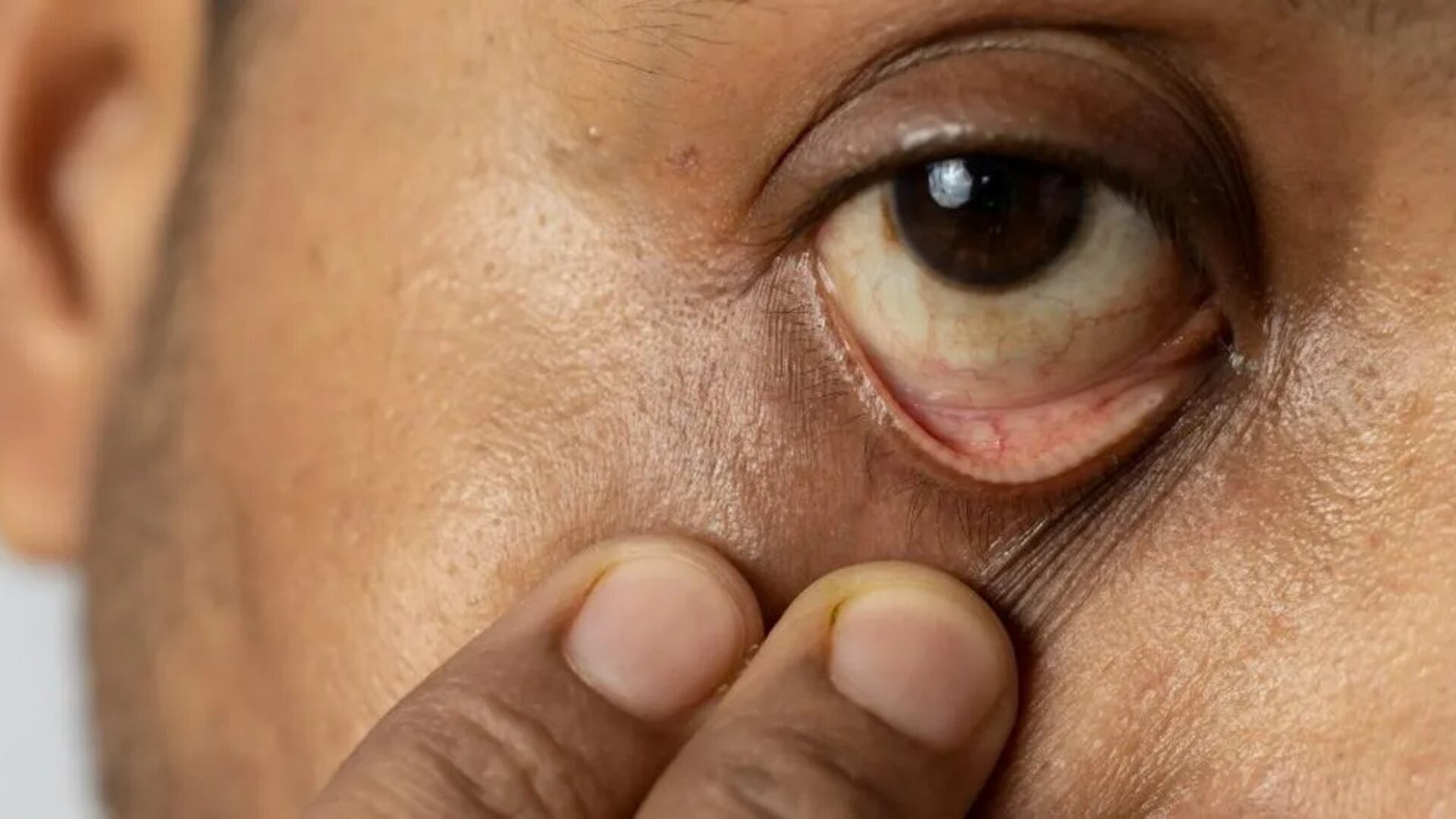 Los cambios en la forma o el tamaño de la pupila es uno de los síntomas del cáncer de ojo (Pulzo)