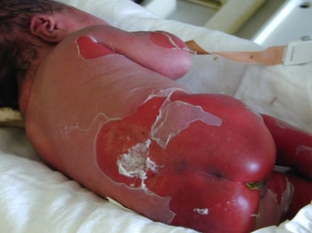 Actualmente el principal tratamiento para