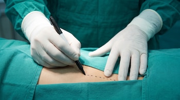 Primer plano de manos enguantadas de blanco marcando la piel del abdomen de un paciente con un rotulador negro, sobre batas quirúrgicas verdes.