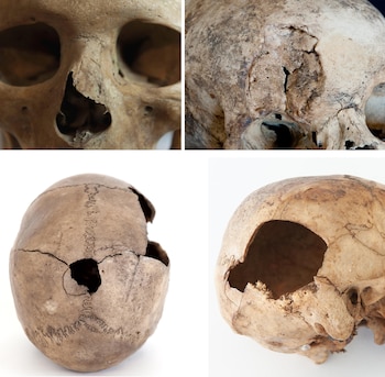 Durante casi 1.300 años, hasta la llegada de los conquistadores europeos en los siglos XIV y XV, los pueblos amazighes que habitaron Gran Canaria conformaron un mundo casi aislado por completo del exterior donde la violencia tuvo un papel estructural en el mantenimiento del orden social. En una muestra de 1.213 cráneos de yacimientos aborígenes de la isla que abarca desde el siglo III al XV, uno de cada tres (33,8 %) presenta traumatismos violentos. Esta imagen de El Museo Canario muestra ubicación de las lesiones detectadas, las curadas (antemortem) y las vinculadas directamente con la muerte del sujeto (perimortem). EFE