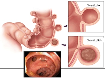 Uno de los síntomas son