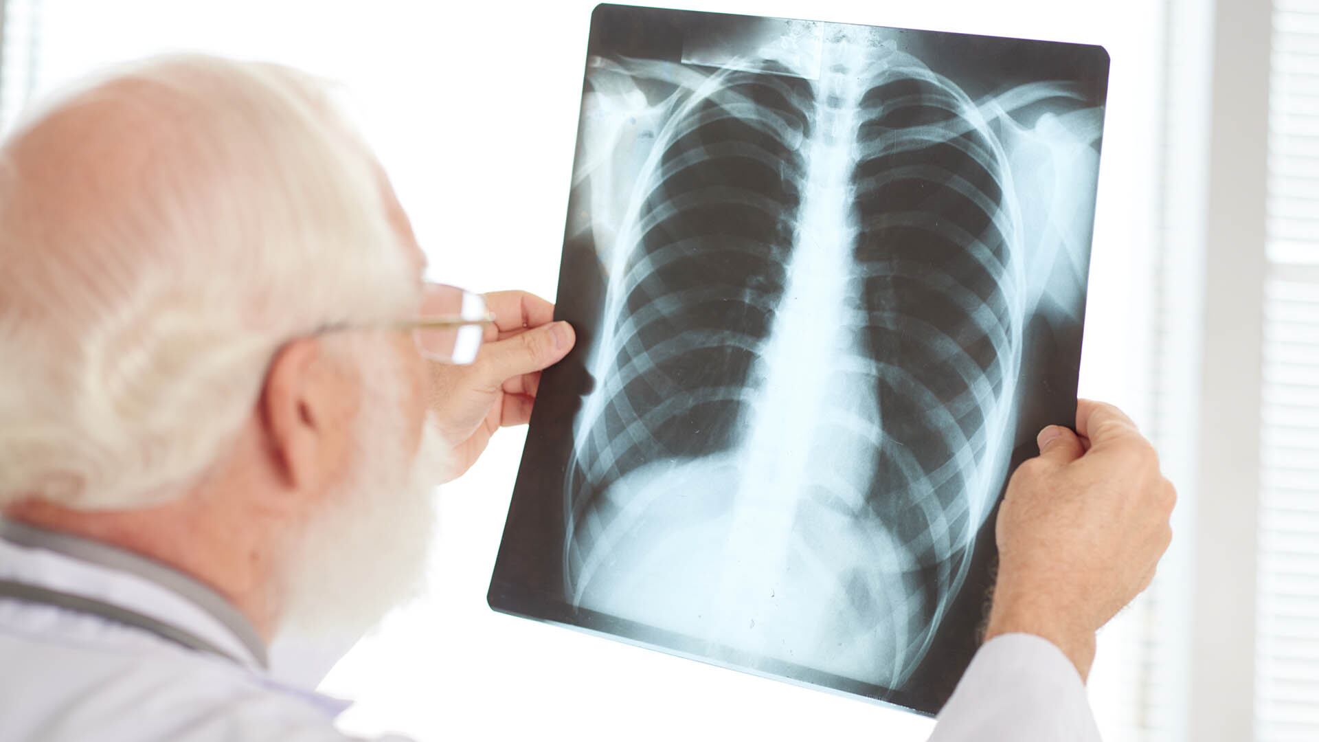 Un estudio en el Hospital Ramos Mejía estimó en 2663 dólares el costo directo promedio por paciente hospitalizado por neumonía por influenza (Freepik)