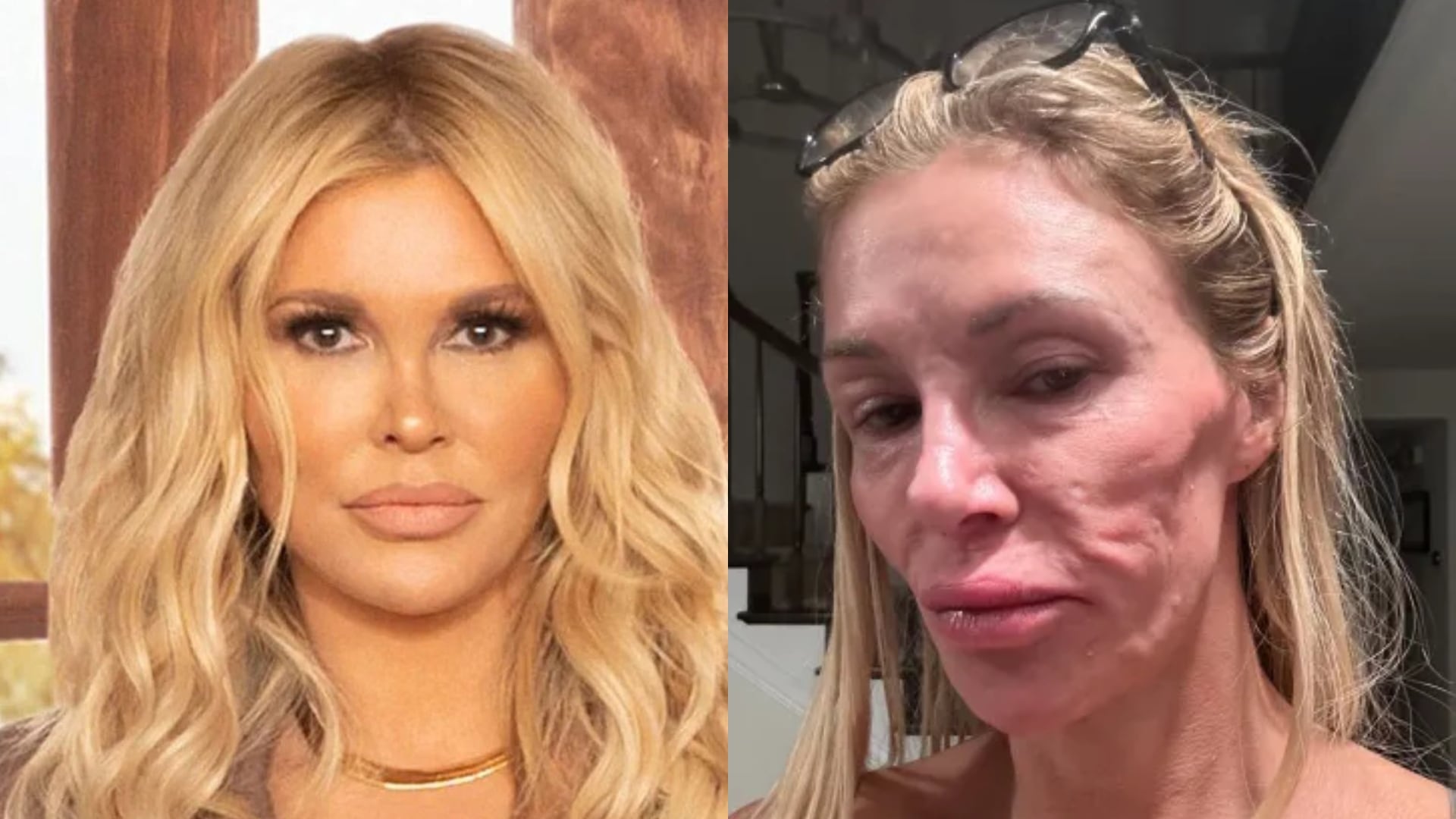 Brandi Glanville dijo que un tumor benigno en un ganglio linfático del rostro podría explicar la acumulación de líquido en su cara - (Bravo/Brandi Glanville/Instagram)