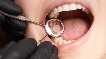 Primer plano de la boca abierta de un paciente durante un examen dental, con un dentista utilizando un espejo para revisar las muelas del juicio.