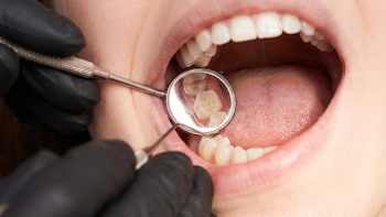 Por qué los humanos tienen muelas de juicio: cómo la evolución del cerebro derivó en mandíbulas más pequeñas y problemas dentales