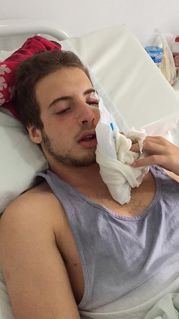 Ivo sufrió una fractura de