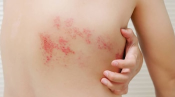 Fiebre, malestar general y erupciones con picazón son algunos de los síntomas frecuentes de la varicela
