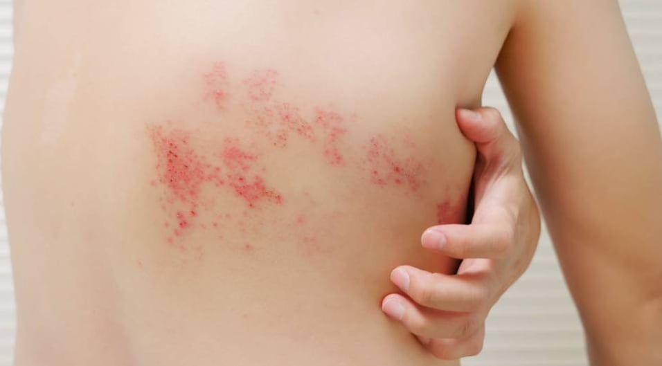 Fiebre, malestar general y erupciones con picazón son algunos de los síntomas frecuentes de la varicela