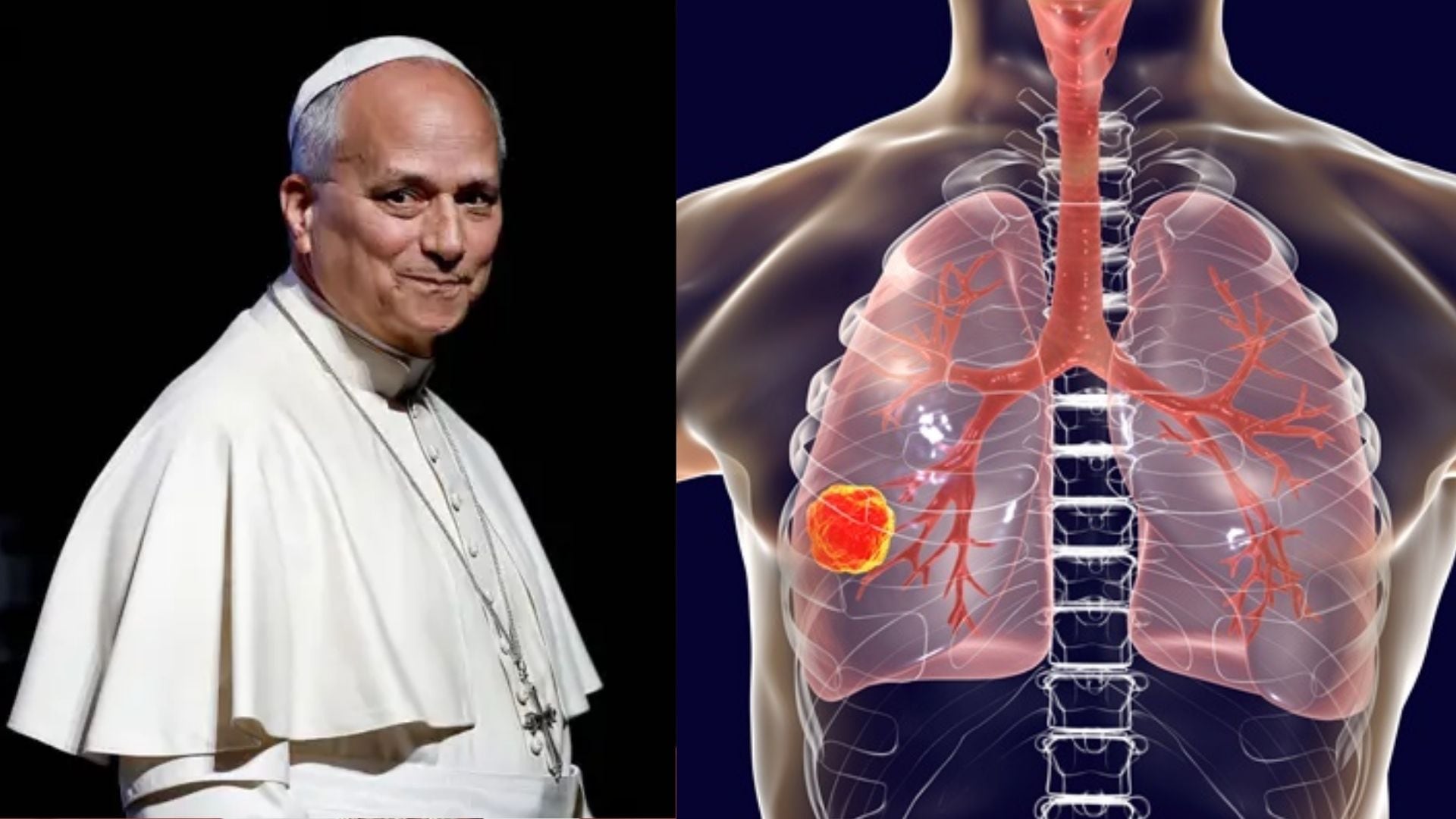 Cómo la operación del Papa León XIV puso en el centro de la escena mundial el futuro del cáncer de pulmón