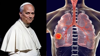 El cáncer que afecta al papa León XIV: neumólogo explica por qué el adenocarcinoma también se relaciona con el tabaco